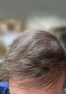 hair transplant photos