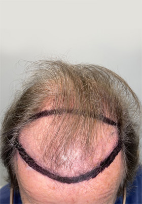 hair transplant before after Photos