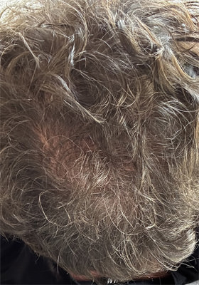 hair transplant photos