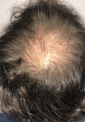 hair transplant before after Photos