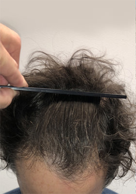 hair transplant photos