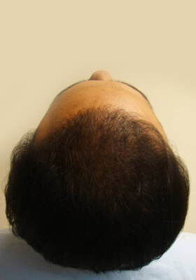 hair transplant photos