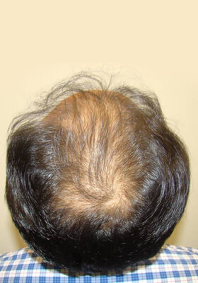 hair transplant photos