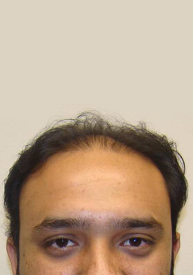 hair transplant photos