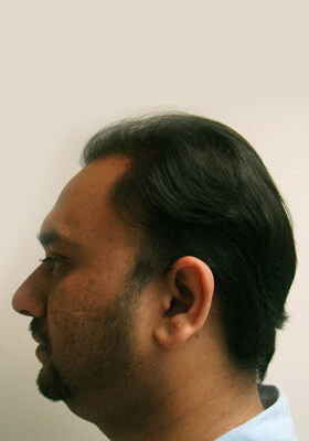 hair transplant photos