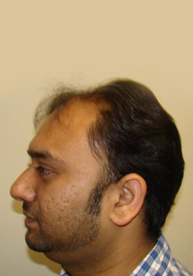 hair transplant photos