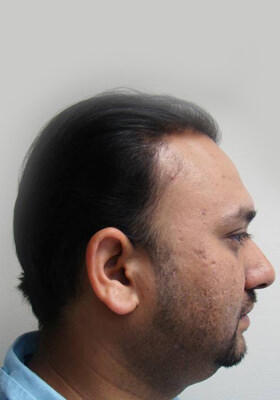 hair transplant photos