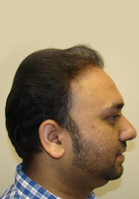 hair transplant photos