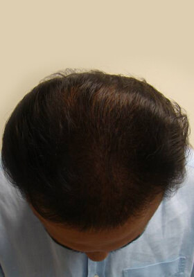 hair transplant before after Photos