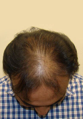 hair transplant photos