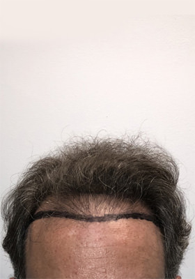 hair transplant before after Photos