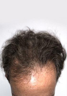 hair transplant before after Photos