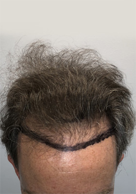 hair transplant before after Photos