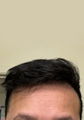 hair transplant before after Photos