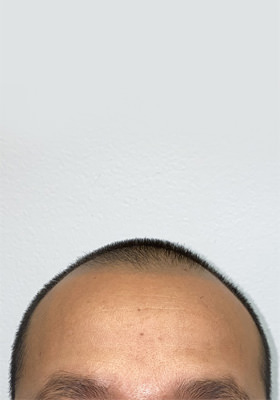 hair transplant before after Photos