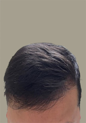 hair transplant before after Photos