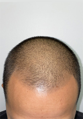 hair transplant before after Photos