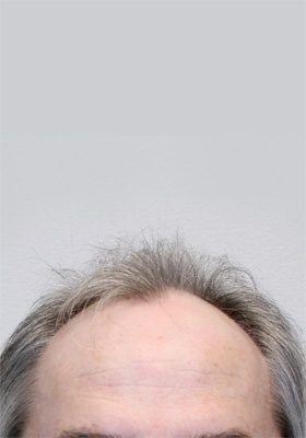 hair transplant before after Photos