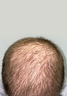 hair transplant before after Photos