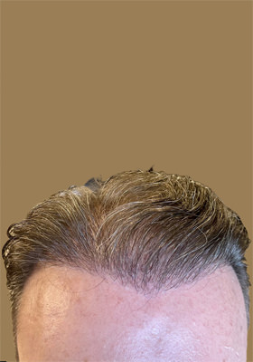 hair transplant before after Photos