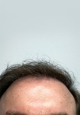 hair transplant before after Photos