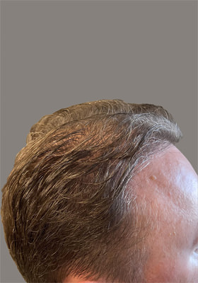 hair transplant before after Photos