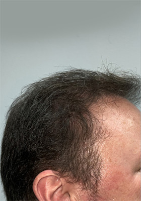 hair transplant before after Photos