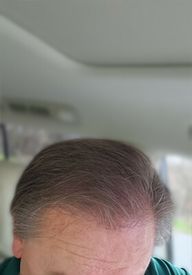 hair transplant before after Photos