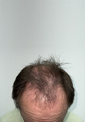 hair transplant before after Photos