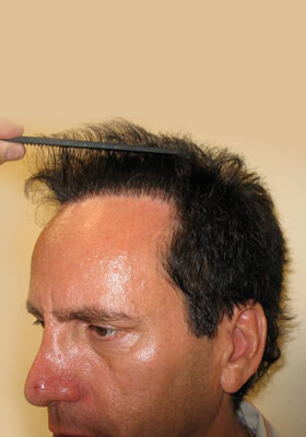 hair transplant photos