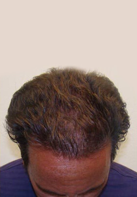 hair transplant before after Photos