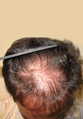 hair transplant before after Photos