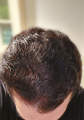 hair transplant before after Photos