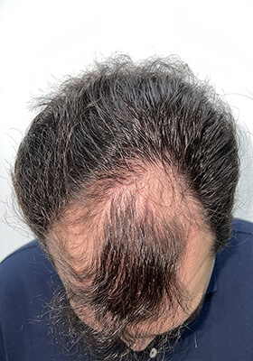 hair transplant before after Photos