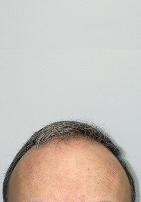 hair transplant before after Photos