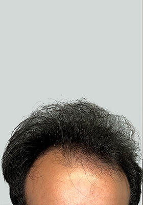 hair transplant before after Photos