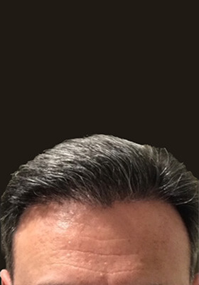 hair transplant before after Photos