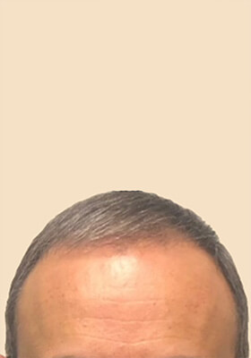 hair transplant before after Photos