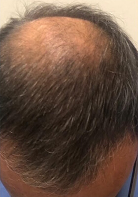 hair transplant before after Photos