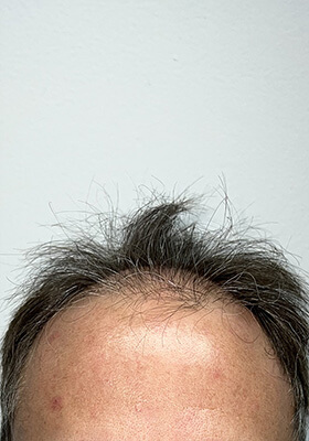 hair transplant before after Photos