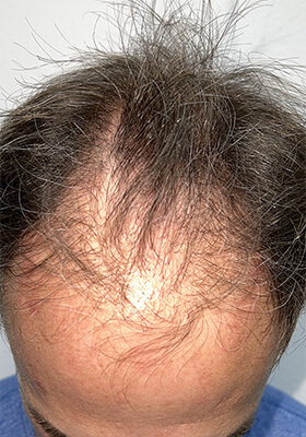 hair transplant before after Photos