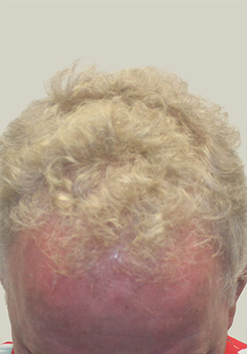 hair transplant before after Photos