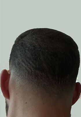 hair transplant before after Photos