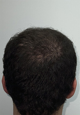 hair transplant before after Photos