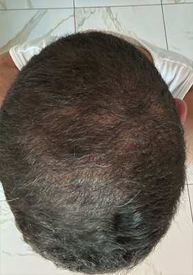 hair transplant before after Photos