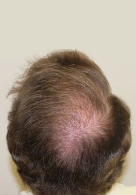 hair transplant photos