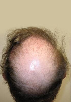 hair transplant photos