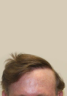 hair transplant photos