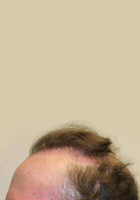 hair transplant photos