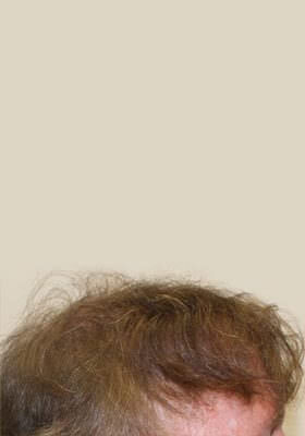 hair transplant photos